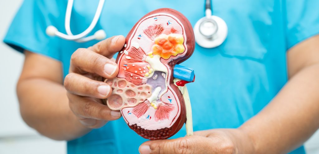 طبيب يحمل مجسم للكلى